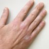 Eine Hand mit Neurodermitis