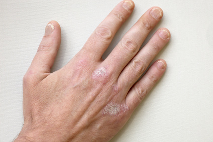 Eine Hand mit Neurodermitis